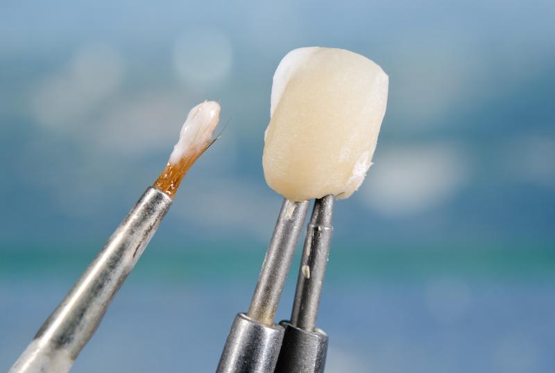 Close up of dental veneers in Springfield, IL