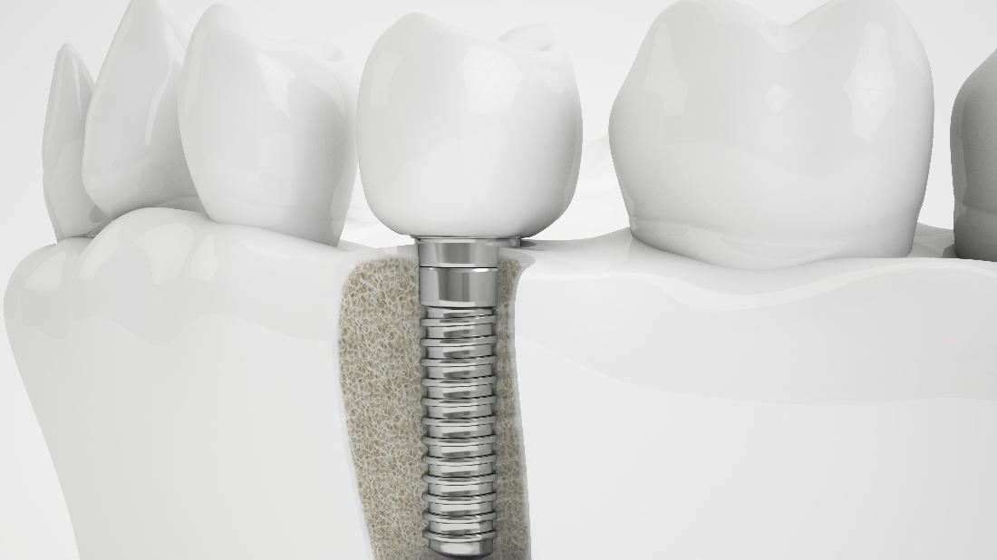 Ruggless Dental Blog | Which Option Looks and Feels the ...