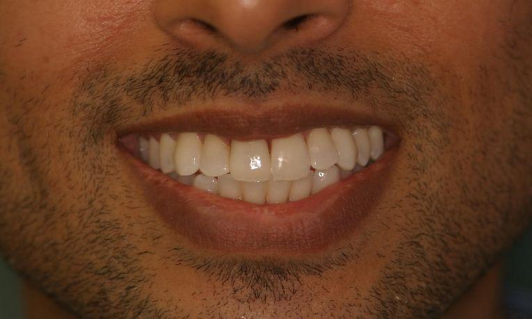 Patients smile after dental crown repair at Ruggless Dental