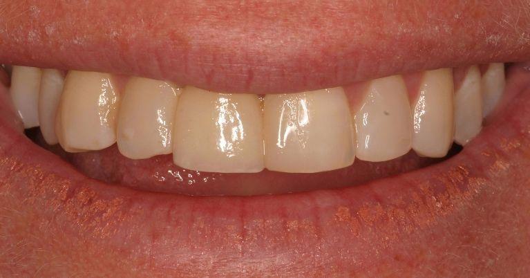 Close up of results from root canal and dental implant restoration in Springfield