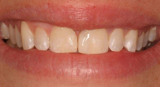 Close up of gap closure with dental bonding in Springfield, IL