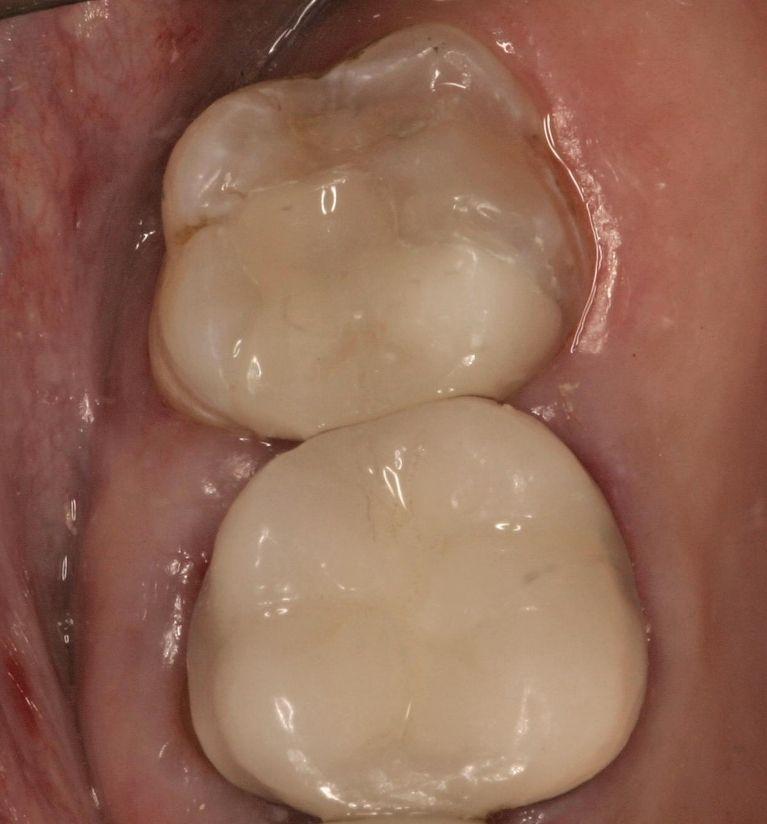 Custom porcelain dental crown on molar at Springfield IL dentist office