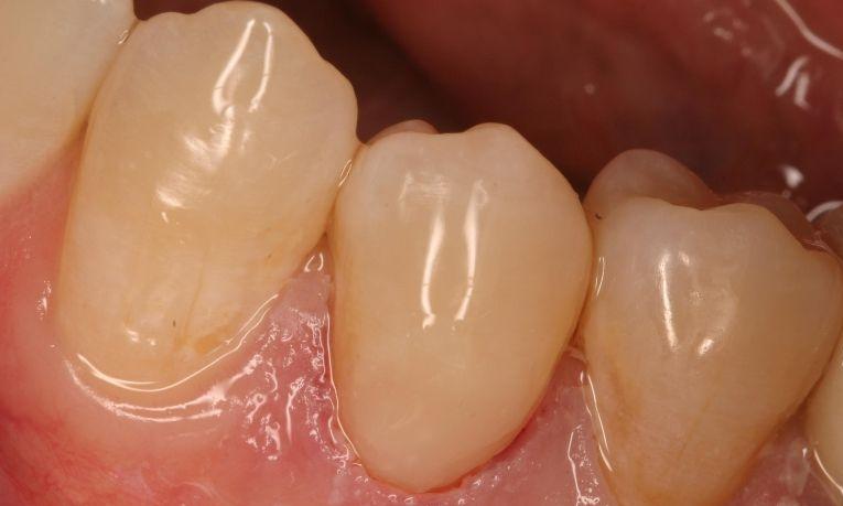 Close up of procedure to fix gum line cavity with dental fillings in Springfield, IL