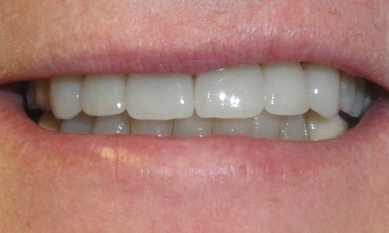 Results from cosmetic dentistry with dental crowns & teeth whitening in Springfield IL