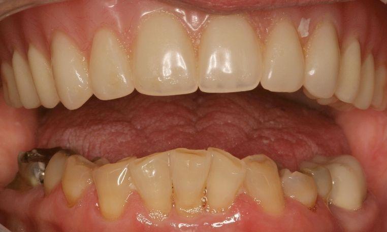 Close up of damaged and discolored teeth at 62704 dental office
