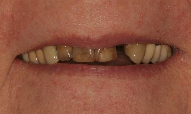 Close up of broken front teeth with severe discoloration at 62704 dentist office