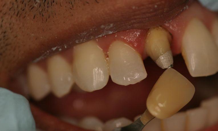 Before image of patient with broken dental crown in Springfield IL