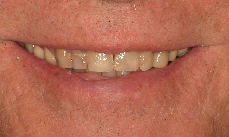 Patients smile with stained and worn down teeth at Ruggless Dental