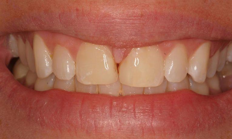 Dental patient with gap in front teeth at Ruggless Dental