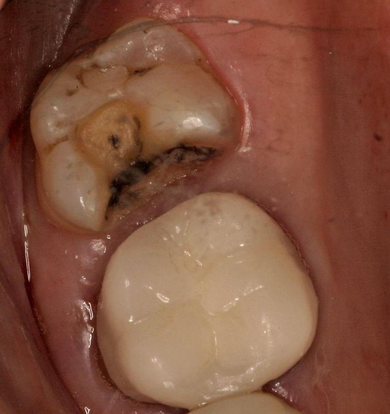Upper molar with old dental filling and cavity at 62704 dentist office
