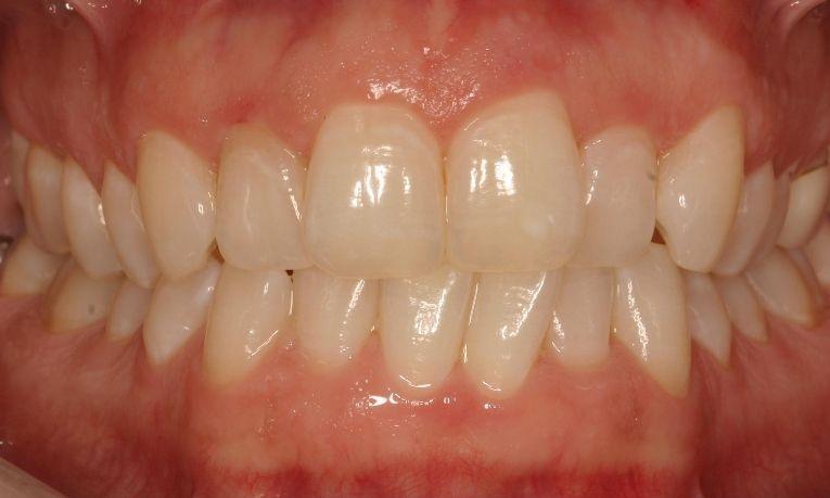 Close up of patient with stained and misaligned teeth at 62704 dentist office