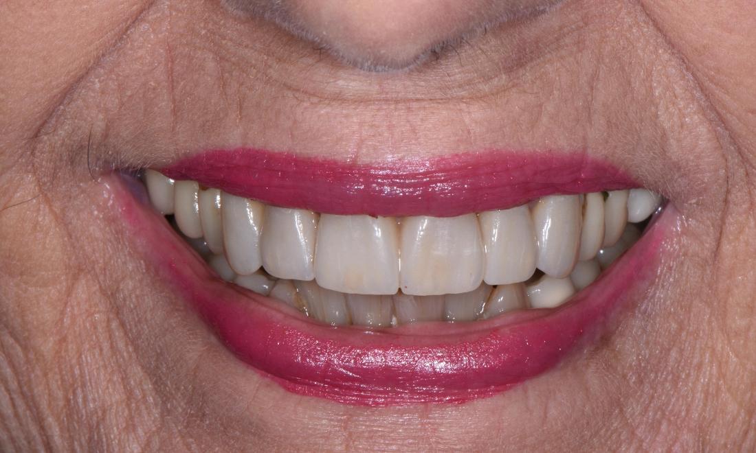 after getting natural looking crowns in springfield, il