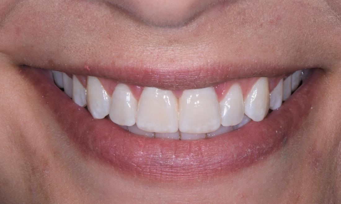 Results from veneers at cosmetic dentist in Springfield IL