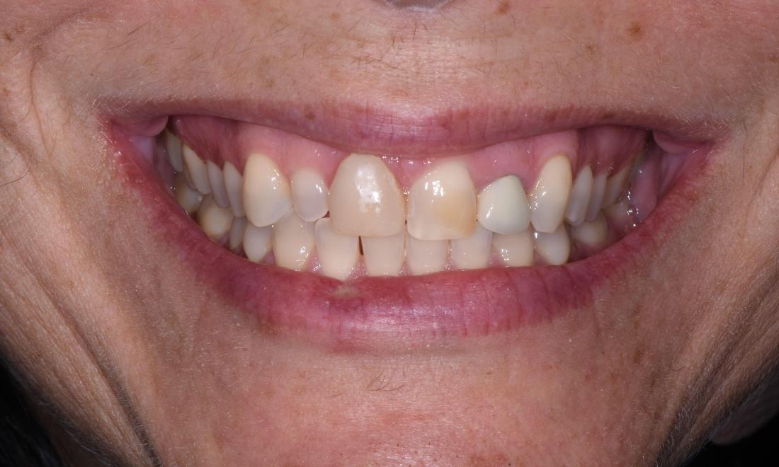 Close up of patient with discolored teeth at dentist near me Springfield IL