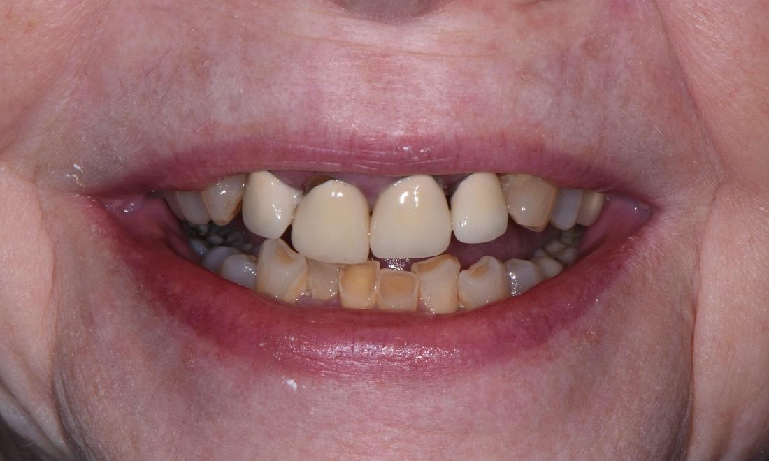 Patient with crooked and discolored teeth at Springfield dentist office