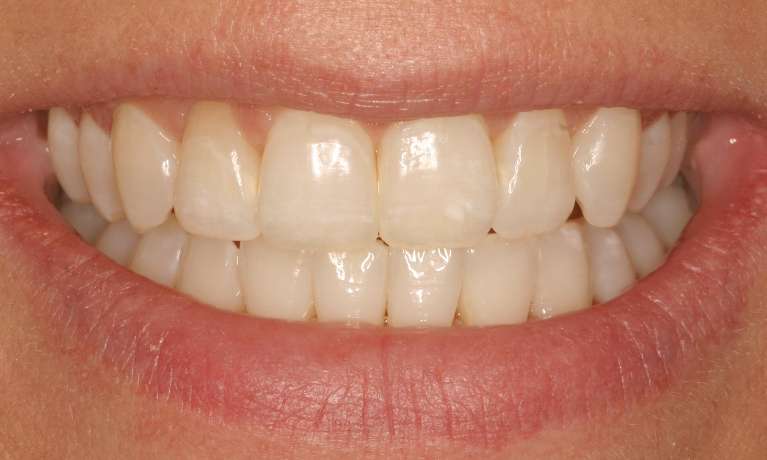 Invisalign-Zoom-Teeth-Whitening-After-Image