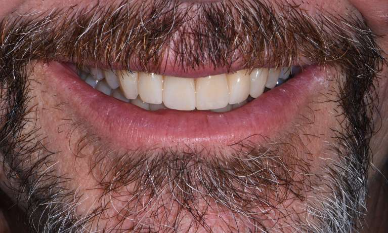 Invisalign-and-Porcelain-Crowns-After-Image