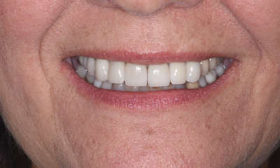 Smile-Makeover-After-Image