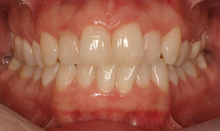 Invisalign-Zoom-Teeth-Whitening-Before-Image