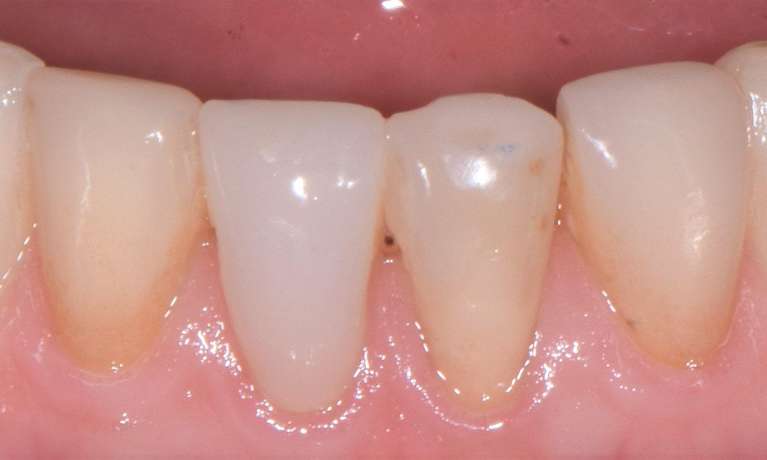 before porcelain crowns