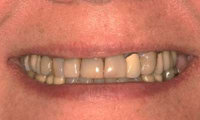 Smile-Makeover-Before-Image